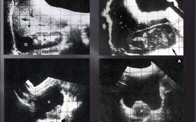 Imágenes de masas renales (fotos superiores) y tumor vesical e hipertrofia benigna de próstata (fotos inferiores)