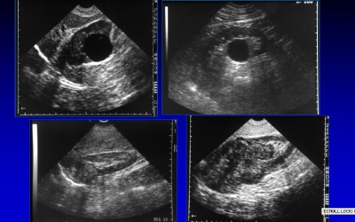 Masas renales: quistes (fotos superiores) y tumores (fotos inferiores)